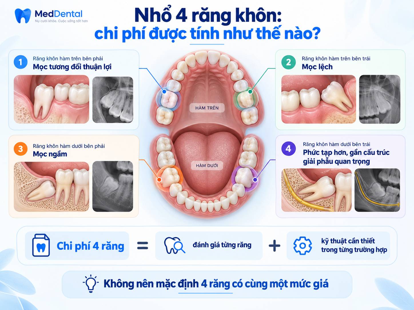 Minh họa bốn răng khôn có mức độ mọc khác nhau và chi phí cần được đánh giá riêng cho từng răng